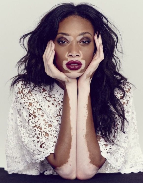 топ модель по американски винни харлоу какой сезон. Winnie Harlow Beauty zpsiuedkpin. топ модель по американски винни харлоу какой сезон фото. топ модель по американски винни харлоу какой сезон-Winnie Harlow Beauty zpsiuedkpin. картинка топ модель по американски винни харлоу какой сезон. картинка Winnie Harlow Beauty zpsiuedkpin